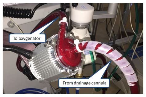 centrifugal ecmo pump|ecmo flow chart.